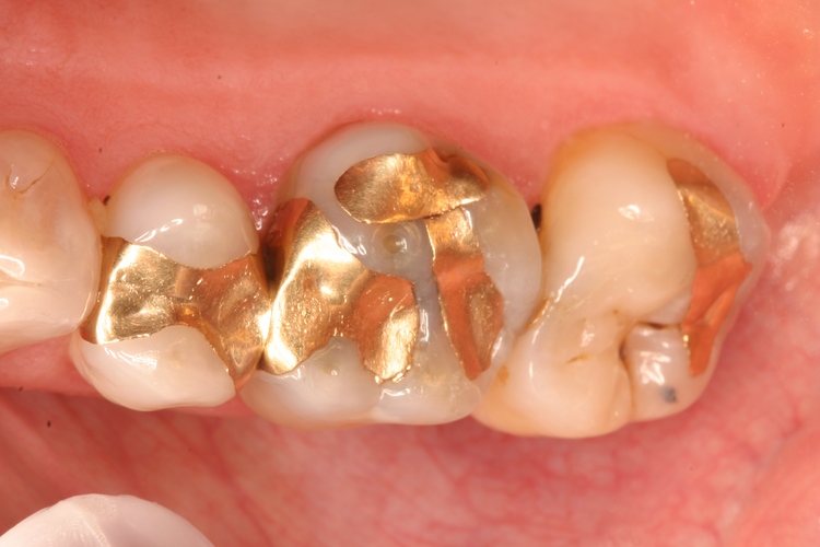 Tooth Fillings: Cast gold